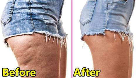 cellulite ärsche|Cellulite .